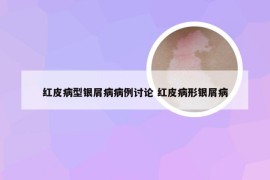 红皮病型银屑病病例讨论 红皮病形银屑病