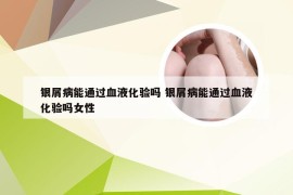 银屑病能通过血液化验吗 银屑病能通过血液化验吗女性