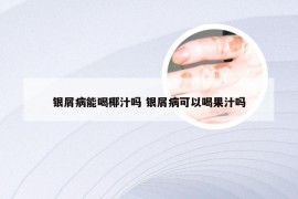 银屑病能喝椰汁吗 银屑病可以喝果汁吗