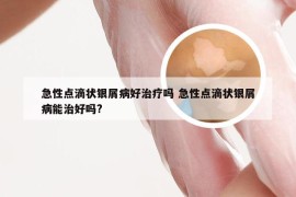 急性点滴状银屑病好治疗吗 急性点滴状银屑病能治好吗?