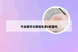 牛皮癣可以擦维生素E胶囊吗