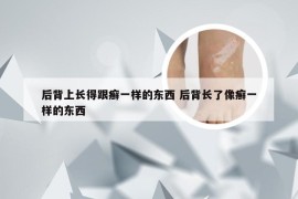 后背上长得跟癣一样的东西 后背长了像癣一样的东西