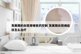 发展期的白斑用哪些药控制 发展期白斑病应该怎么治疗