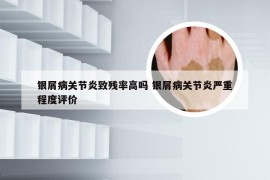 银屑病关节炎致残率高吗 银屑病关节炎严重程度评价