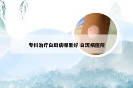 专科治疗白斑病哪里好 白斑病医院