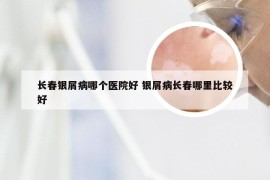 长春银屑病哪个医院好 银屑病长春哪里比较好