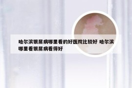 哈尔滨银屑病哪里看的好医院比较好 哈尔滨哪里看银屑病看得好