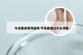 牛皮廨容易传染吗 牛皮廨通过什么传染