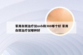 家用白斑治疗仪uvb和308哪个好 家用白斑治疗仪哪种好