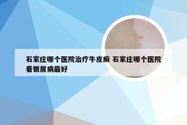 石家庄哪个医院治疗牛皮癣 石家庄哪个医院看银屑病最好