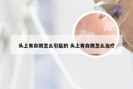 头上有白斑怎么引起的 头上有白斑怎么治疗