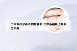 三周岁孩子身长的皮肤癣 三岁小孩身上长癣怎么办