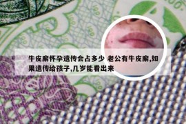 牛皮廨怀孕遗传会占多少 老公有牛皮廨,如果遗传给孩子,几岁能看出来