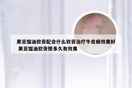 黑豆馏油软膏配合什么软膏治疗牛皮癣效果好 黑豆馏油软膏擦多久有效果