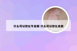 什么可以软化牛皮癣 什么可以软化皮肤