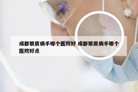 成都银屑病手哪个医院好 成都银屑病手哪个医院好点