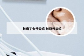 长癣了会传染吗 长藓传染吗