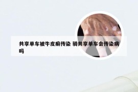 共享单车被牛皮癣传染 骑共享单车会传染病吗