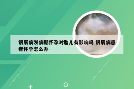 银屑病发病期怀孕对胎儿有影响吗 银屑病患者怀孕怎么办