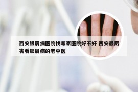 西安银屑病医院找哪家医院好不好 西安最厉害看银屑病的老中医