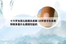 十六岁女孩儿轻度头皮癣 16岁孩子头皮屑特别多是什么原因引起的