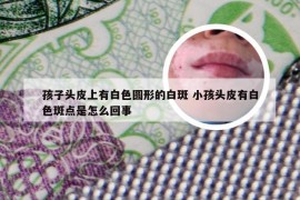 孩子头皮上有白色圆形的白斑 小孩头皮有白色斑点是怎么回事