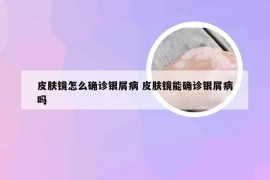 皮肤镜怎么确诊银屑病 皮肤镜能确诊银屑病吗