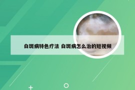 白斑病特色疗法 白斑病怎么治的短视频