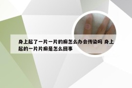 身上起了一片一片的癣怎么办会传染吗 身上起的一片片癣是怎么回事