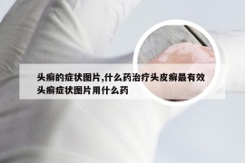 头癣的症状图片,什么药治疗头皮癣最有效 头癣症状图片用什么药