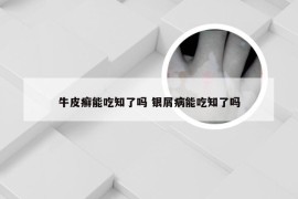 牛皮癣能吃知了吗 银屑病能吃知了吗