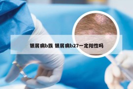 银屑病b族 银屑病b27一定阳性吗