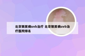 北京银屑病uvb治疗 北京银屑病uvb治疗医院排名