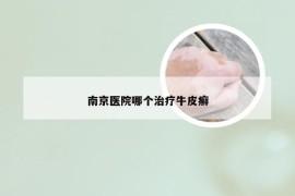 南京医院哪个治疗牛皮癣