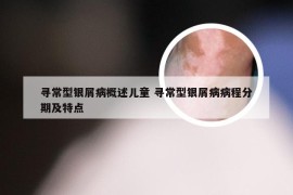 寻常型银屑病概述儿童 寻常型银屑病病程分期及特点