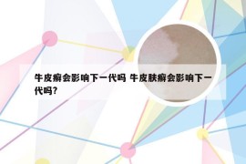 牛皮癣会影响下一代吗 牛皮肤癣会影响下一代吗?