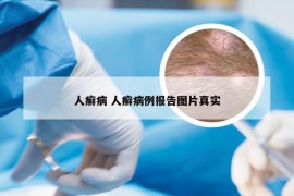 人癣病 人癣病例报告图片真实