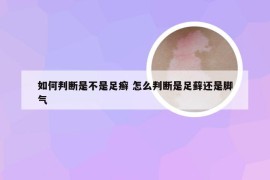 如何判断是不是足癣 怎么判断是足藓还是脚气