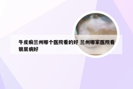 牛皮癣兰州哪个医院看的好 兰州哪家医院看银屑病好