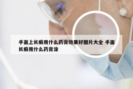 手面上长癣用什么药膏效果好图片大全 手面长癣用什么药膏涂