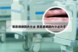 银屑病病因内分泌 银屑病病因内分泌异常