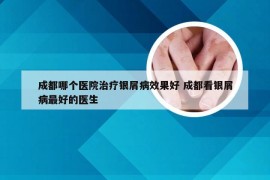 成都哪个医院治疗银屑病效果好 成都看银屑病最好的医生