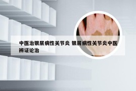 中医治银屑病性关节炎 银屑病性关节炎中医辨证论治