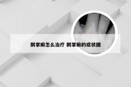 鹅掌癣怎么治疗 鹅掌癣的症状图