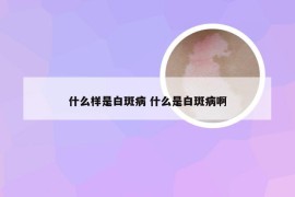 什么样是白斑病 什么是白斑病啊