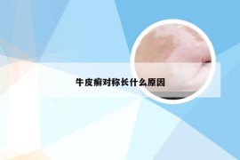 牛皮癣对称长什么原因