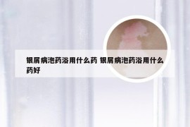 银屑病泡药浴用什么药 银屑病泡药浴用什么药好