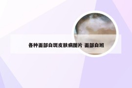 各种面部白斑皮肤病图片 面部白班