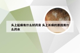 头上起癣有什么好药膏 头上长癣的原因用什么药水