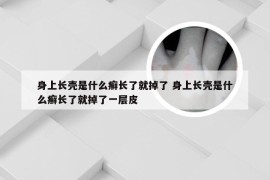 身上长壳是什么癣长了就掉了 身上长壳是什么癣长了就掉了一层皮